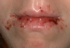 Behandlung von Akne - Ordination Haut im Zentrum - Eisenstadt