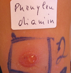 Untersuchung Allergie - Ordination Haut im Zentrum - Eisenstadt