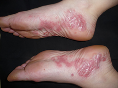 Behandlung von Psoriasis - Ordination Haut im Zentrum - Eisenstadt