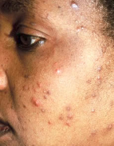 Behandlung von Akne - Ordination Haut im Zentrum - Eisenstadt