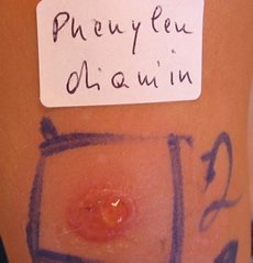 Untersuchung Allergie - Ordination Haut im Zentrum - Eisenstadt